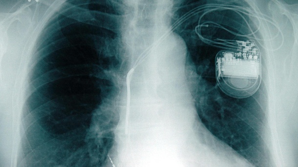 Hackers can attack pacemakers