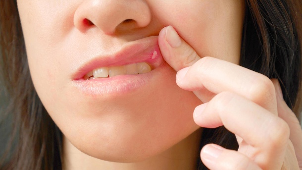 Aphthens: What is behind the small ulcers in the mouth?